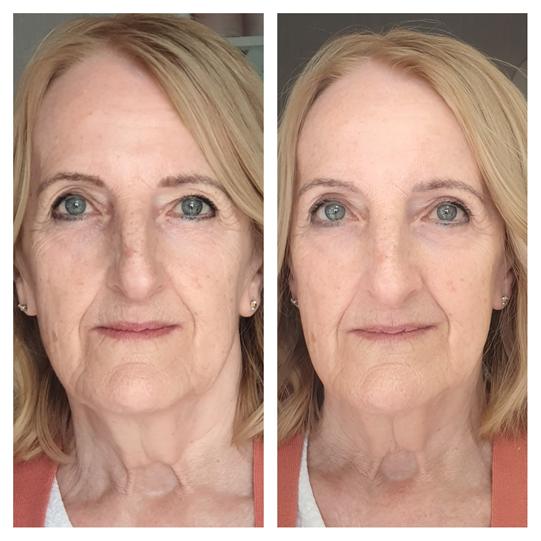 MG B4 and After 1 treatment